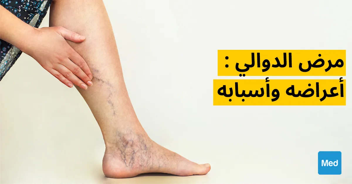 مرض الدوالي : أعراضه وأسبابه